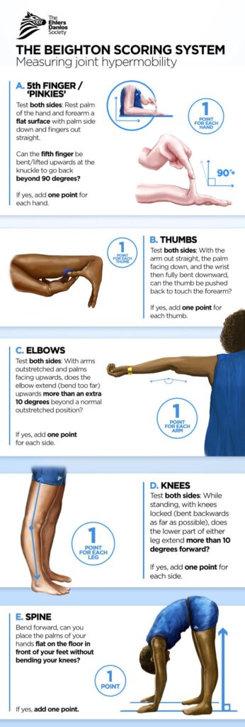 Ehlers-Danlos Syndrome